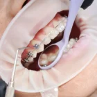 Brackets metálicos, de zafiro o cerámica cómo elegir entre los tres materiales ortodoncia en burgos sanchez arranz