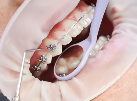 Brackets metálicos, de zafiro o cerámica cómo elegir entre los tres materiales ortodoncia en burgos sanchez arranz
