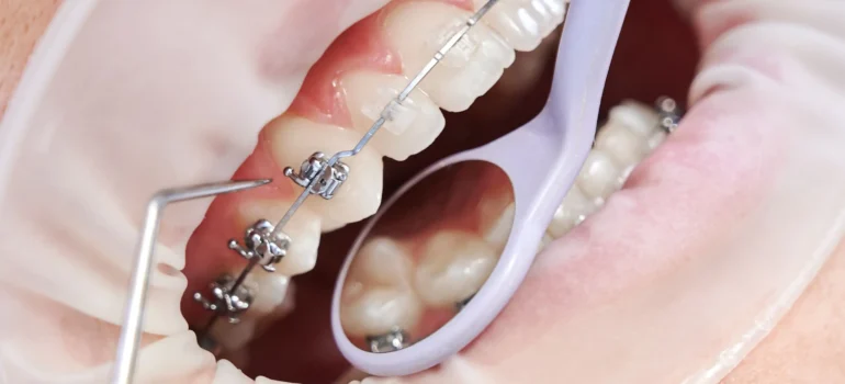 Brackets metálicos, de zafiro o cerámica cómo elegir entre los tres materiales ortodoncia en burgos sanchez arranz