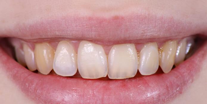 tratamiento fluorosis dental