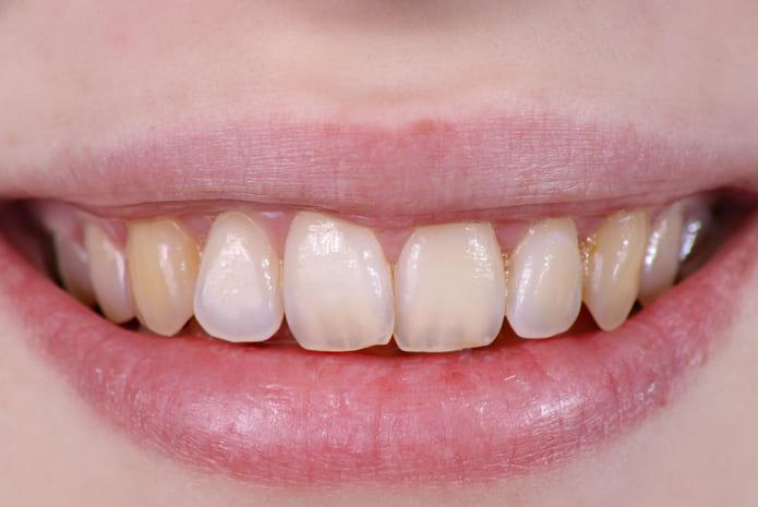 tratamiento fluorosis dental