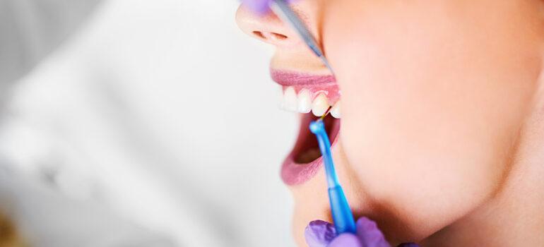 gingivitis y periodontitis