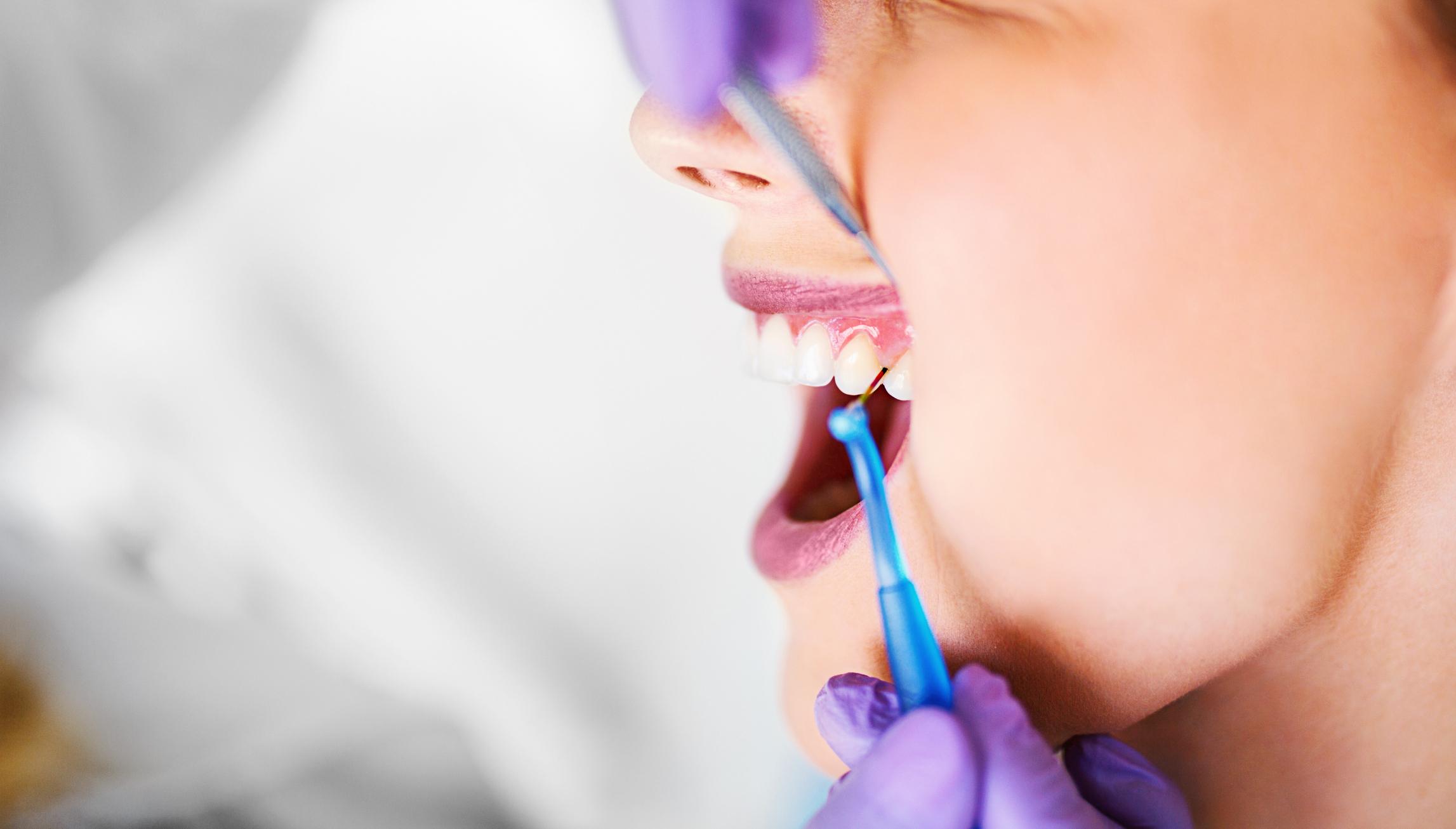 gingivitis y periodontitis