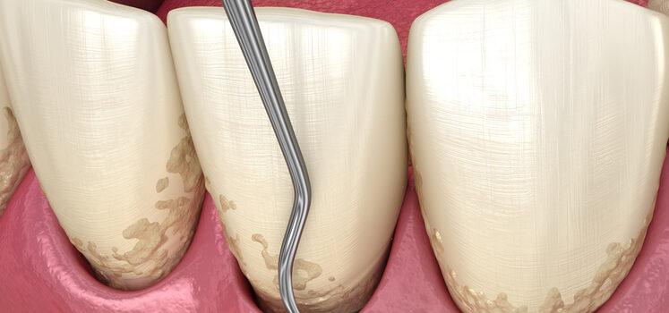 curetaje periodontal