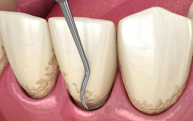 curetaje periodontal