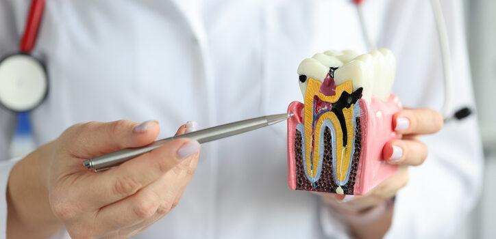 por qué algunas personas tienen más caries