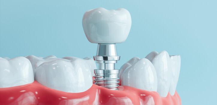 implantes dentales Burgos