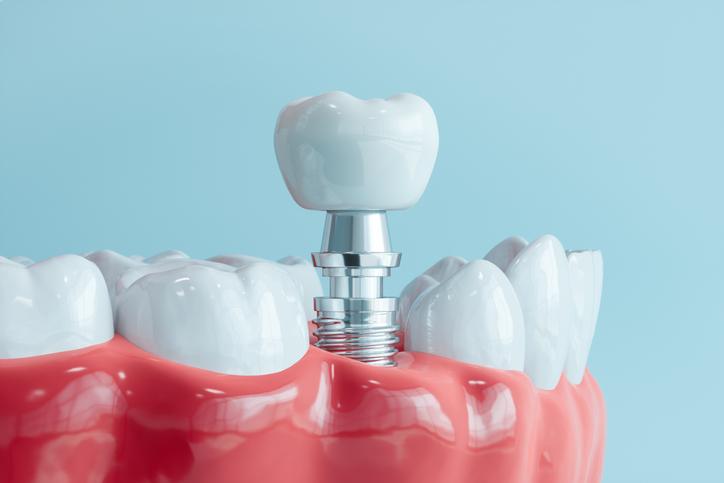 implantes dentales Burgos