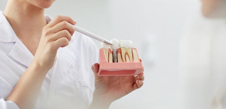 mitos y realidades sobre los implantes dentales