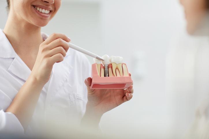 mitos y realidades sobre los implantes dentales