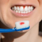 sangrar después del cepillado periodoncia en burgos clinica sanchez arranz