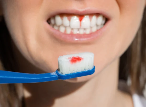 sangrar después del cepillado periodoncia en burgos clinica sanchez arranz