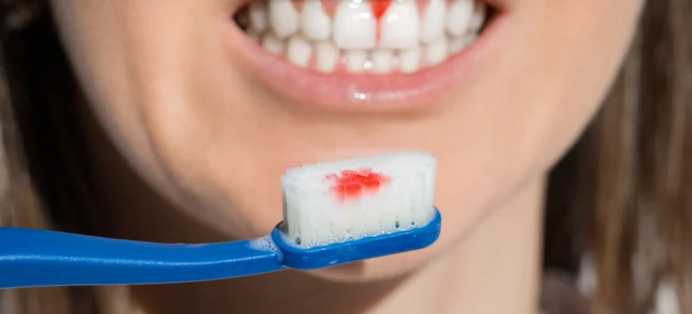 sangrar después del cepillado periodoncia en burgos clinica sanchez arranz