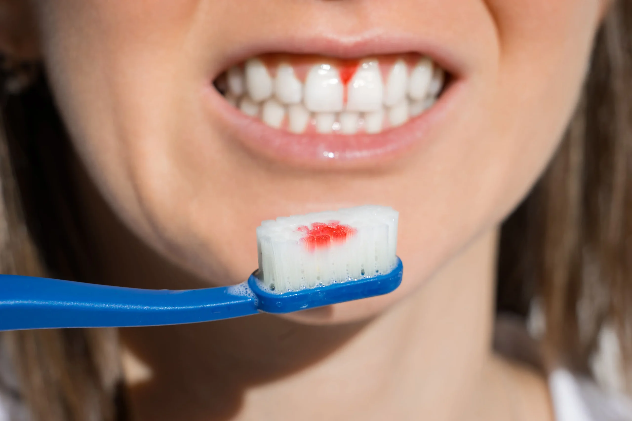 sangrar después del cepillado periodoncia en burgos clinica sanchez arranz